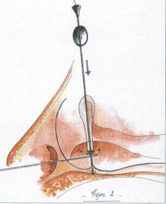 Ritleng mono-canalicular stent