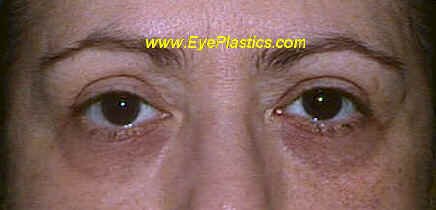 Pre-Operative photo demonstrating, infraorbital hollowing