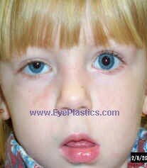Marcus Gunn Jaw wink ptosis is an example of synkinesis (an abnormal innervation connecting two groups of normally UNRELATED muscles)