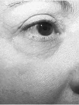 The pulsed laser can also remove scars, blemishes, and growths.