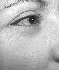 The pulsed laser can also remove scars, blemishes, and growths.