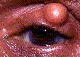 Inflammatory Lesions