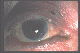 Eyelid Maligancies