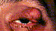 Eyelid Maligancies