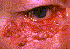 Eyelid Maligancies