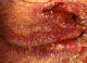 Eyelid Maligancies