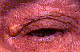 Other Eyelid Lesions