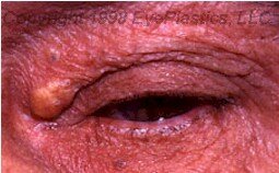 Xanthelasma