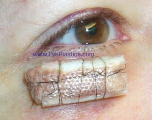 Excision of the tumor can be performed by a MOHS surgeon, an dermatologist, or an ophthalmic plastic surgeon