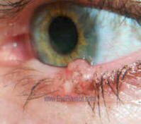 Pre - Operative photo of basal cell carcinoma of the left lower lid