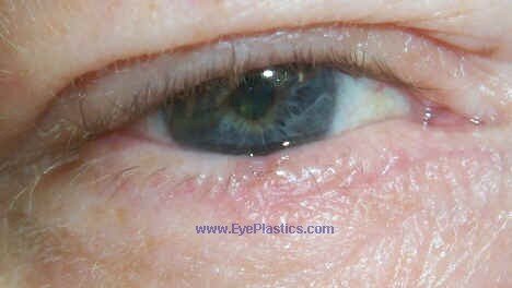 Excision of the tumor can be performed by a MOHS surgeon, an dermatologist, or an ophthalmic plastic surgeon