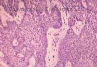 Since both basal and squamous cell carcinoma are relatively slow growing, if they are detected early and treated in a prompt and appropriate manner, there is an excellent chance of removing the tumor completely and minimizing the amount of tissue affected by the carcinoma