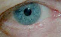 Excision of the tumor can be performed by a MOHS surgeon, an dermatologist, or an ophthalmic plastic surgeon