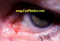 The most common types of skin cancers are basal cell carcinoma and squamous cell carcinoma.