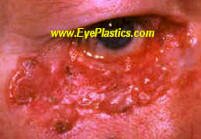 The most common types of skin cancers are basal cell carcinoma and squamous cell carcinoma.