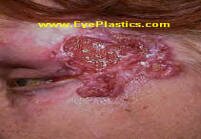 Since both basal and squamous cell carcinoma are relatively slow growing, if they are detected early and treated in a prompt and appropriate manner, there is an excellent chance of removing the tumor completely and minimizing the amount of tissue affected by the carcinoma