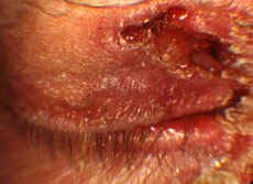 Squamous Cell Carcino