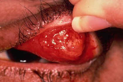 Photo of Sebaceous Cell Carcinoma