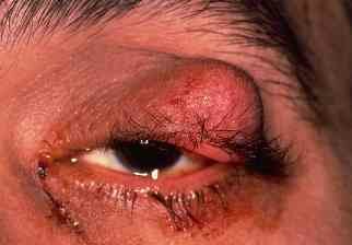 Photo of Sebaceous Cell Carcinoma