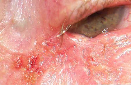 Sebaceous Cell Carcinoma involving the right upper, lateral and lower eyelid.