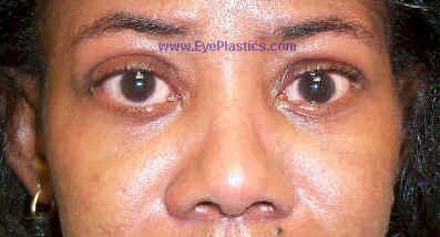 Upper Eyelid Retraction I ost - Operative - 2 weeks after lowering upper eyelids