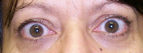 re-Operative Photograph showing upper eyelid retraction