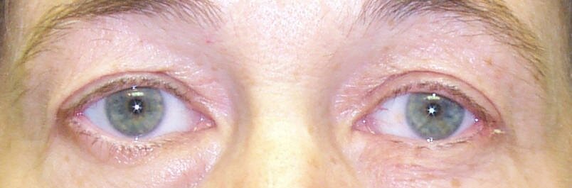 Post-Operative Photograph showing normal upper eyelid position