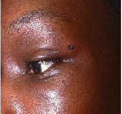 BB lodged in Skin