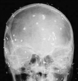 Shot-gun to face and the patient lost vision in both eyes.