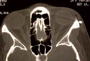 BB lodged in Skin