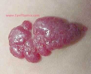 Orbital Tumors - Capillary Hemangioma (Benign Hemangioendothelioma)