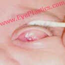 Orbital Tumors - Capillary Hemangioma (Benign Hemangioendothelioma)