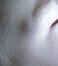 Orbital Tumors - Lacrimal Gland Tumors