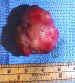 Adults: vascular orbital tumor