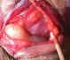 Adults: neural orbital tumor