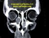 Adults: other orbital tumor