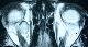 Adults: vascular orbital tumor