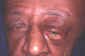 Adults: other orbital tumor