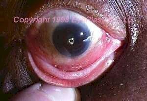Adults: hematopoietic obital tumor