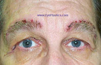 Post-Operative photograph: Brow Ptosis, excess skin, 6 days
