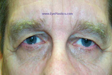 Pre-Operative photograph: Brow Ptosis, excess skin