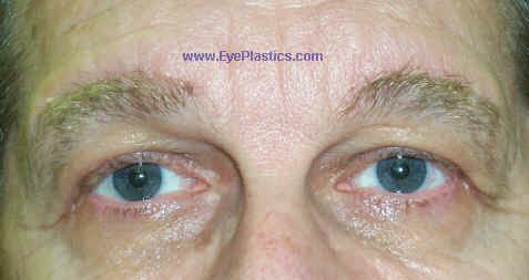 Pre-Operative photograph: Brow Ptosis, excess skin: 1 month