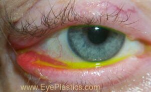 Ectropion