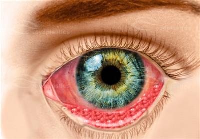 Chlamidial Conjunctivitis