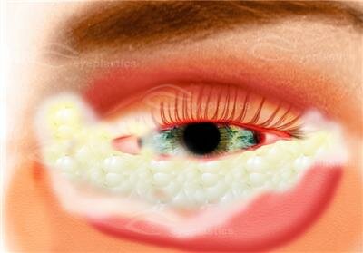 conjunctivitis