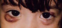 Chalazion