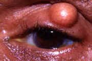Chalazion