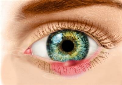 Chalazion